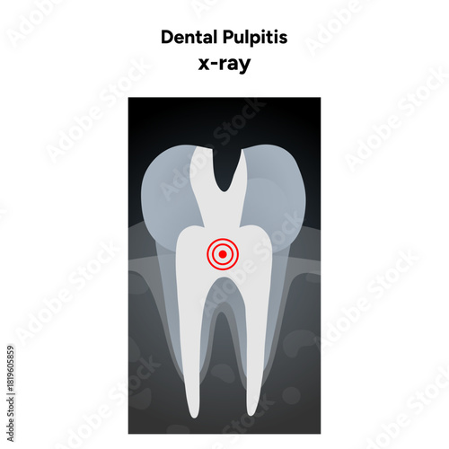 Hand-drawn dental infographic of pulpitis X-ray  internal anatomy of  tooth, including pulp chamber and root canals. Educational illustration suitable for dental clinics, oral health guide