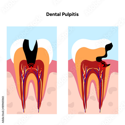 Hand-drawn dental infographic of pulpitis anatomy, inflamed tooth pulp, root canals, and internal structure. Educational illustration ideal for dental clinics, oral health guides, medical posters