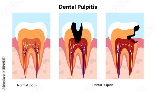 Hand-drawn dental infographic of pulpitis anatomy, inflamed tooth pulp, root canals, and internal structure. Educational illustration ideal for dental clinics, oral health guides, medical posters