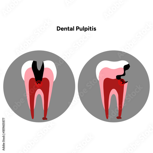 Hand-drawn dental infographic of pulpitis anatomy, inflamed tooth pulp, root canals, and internal structure. Educational illustration ideal for dental clinics, oral health guides, medical posters