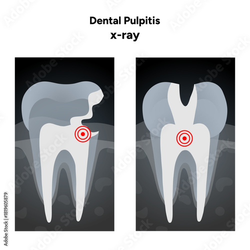 Hand-drawn dental infographic of pulpitis X-ray  internal anatomy of  tooth, including pulp chamber and root canals. Educational illustration suitable for dental clinics, oral health guide