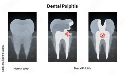 Hand-drawn dental infographic of pulpitis X-ray  internal anatomy of  tooth, including pulp chamber and root canals. Educational illustration suitable for dental clinics, oral health guide
