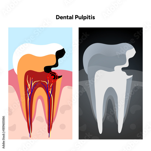 Hand-drawn dental infographic of pulpitis anatomy with X-ray view, inflamed tooth pulp, root canals, and internal structure. Educational illustration for dental 