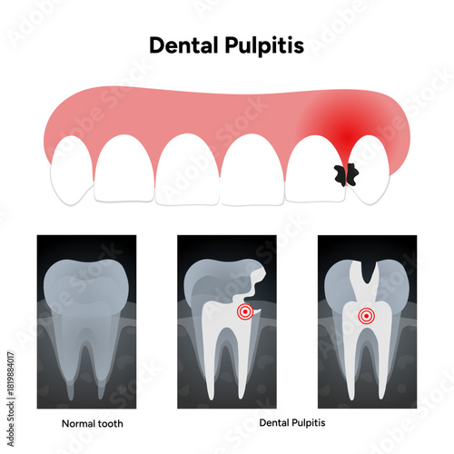 Hand-drawn dental infographic dental pulpitis with X-ray. Educational illustration tooth, inflamed pulp, and dental issues