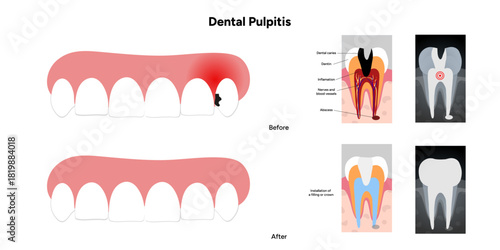 Hand-drawn dental infographic of dental pulpitis anatomy, root canal treatment, and X-ray view. Educational illustration for dentistry