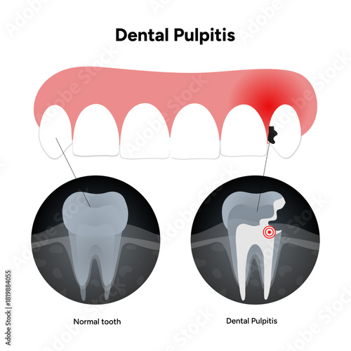 Hand-drawn dental infographic dental pulpitis with X-ray. Educational illustration tooth, inflamed pulp, and dental issues
