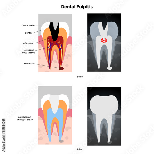 Hand-drawn dental infographic of dental pulpitis anatomy, root canal treatment, and X-ray view. Educational illustration for dentistry