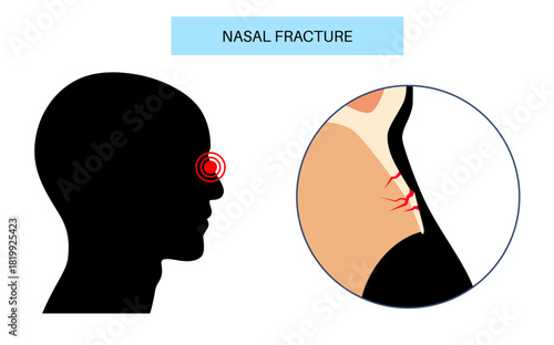 Nasal fracture poster