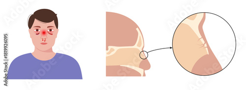 Nasal fracture poster
