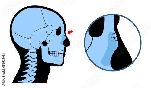 Nasal fracture poster