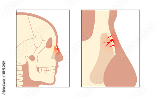 Nasal fracture poster