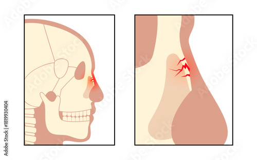 Nasal fracture poster