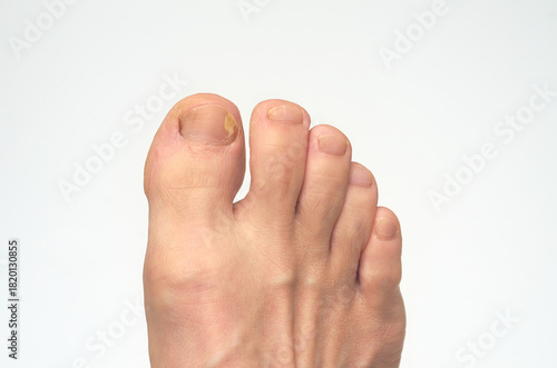 남성의 발톱 무좀 클로즈업 흰색배경