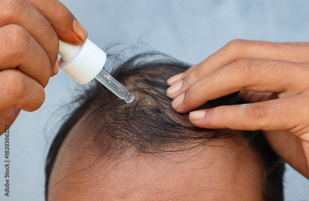 Naklejka premium An Asian man is dripping with pipette a hair nourishing serum on a thinning head area. Focus on the head. 