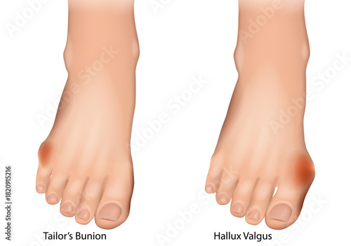 Tailor’s Bunion bunionette and Hallux Valgus Medical Illustration. Foot Deformities Comparison. Bunionette and Hallux Valgus