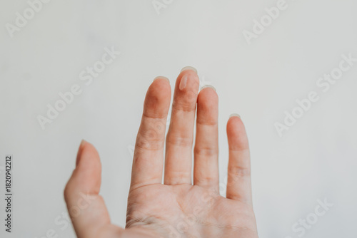 Close-up of a woman’s hand with skin irritation on the finger — real skin texture, dermatology concept
