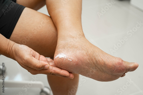Asian woman check feet with crack and dry heel skin, Diabetic Foot.