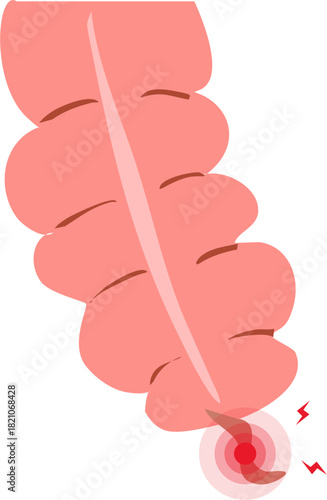 Appendicitis illustration