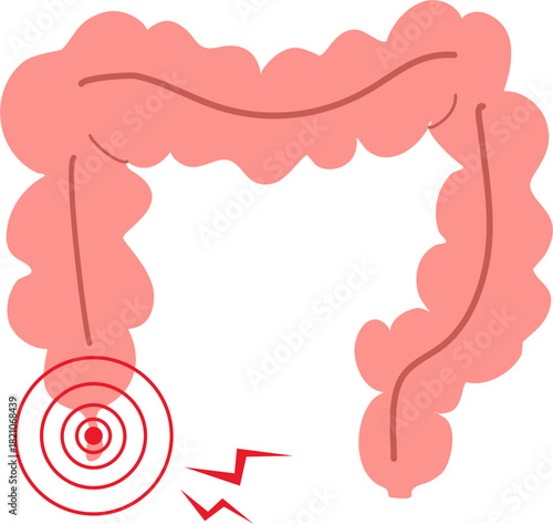 Appendicitis illustration