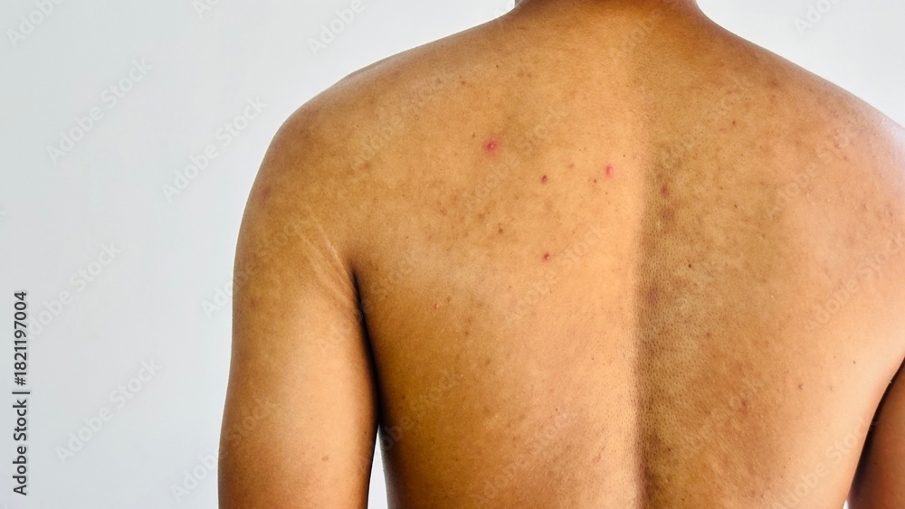 Fototapeta premium scars on human back acne. used for health