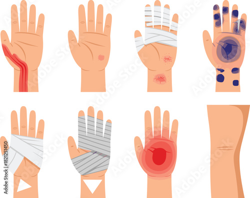 Hand injury illustration set, medical bandages, bruises, cuts, inflammation, treatment stages, healthcare vector, anatomy, emergency care