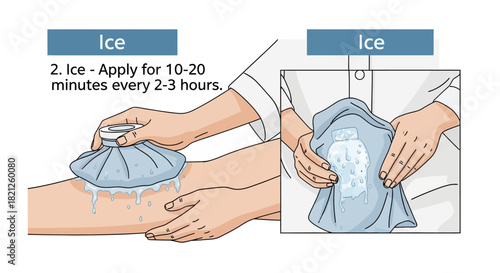 Applying an ice pack to leg for pain relief and swelling reduction, with instructions for duration and frequency