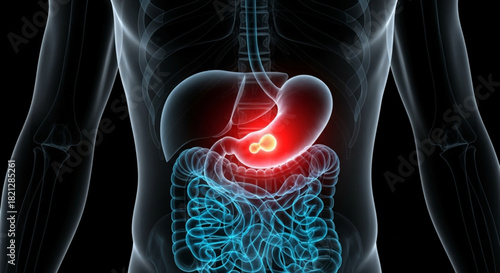 Anatomical x ray visualization of the human torso with stomach inflammation and tumor highlighted in red
