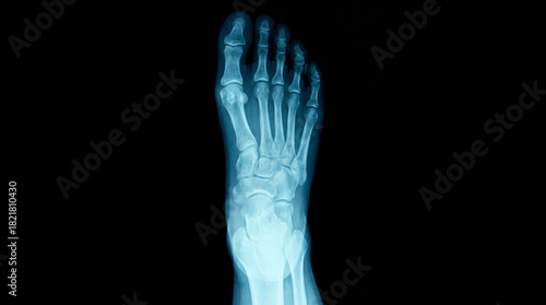 Foot x-ray image medical diagnostic scan isolated on black background