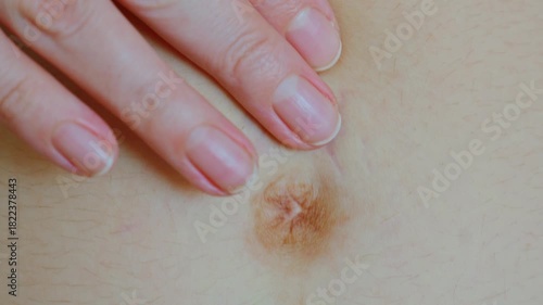 Close-up woman touching postpartum stretch marks on an adult female abdomen. Skin changes after childbirth