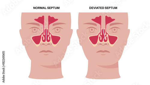 Deviated septum poster