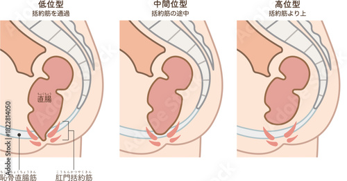 鎖肛のイラスト、imperforate anus(ARM) illustration