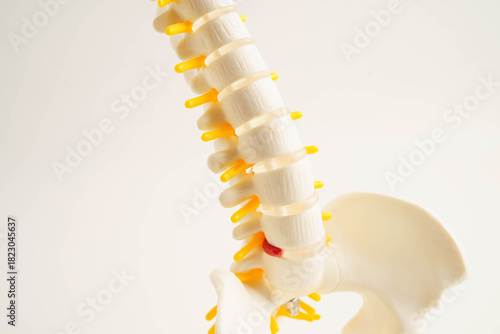 Spinal nerve and bone, Lumbar spine displaced herniated disc fragment, Model for treatment medical in the orthopedic department.