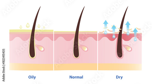 Comparison of oily, normal and dry skin vector illustration. Cross section of oily skin overproduction of sebum, normal skin keep moisturize, prevent water loss and lack of sebum in dry skin.