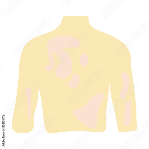 Tinea Versicolor on Human Back Skin