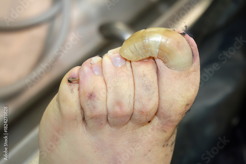 Canvas Print Severe Onychogryphosis Claw Toe Nail Foot Forensic Medical Pathology
