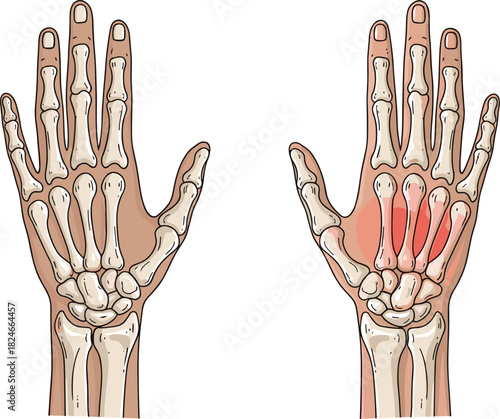 Human hand anatomy illustration, skeletal structure, metacarpal inflammation, medical condition, red pain zone, educational health diagram