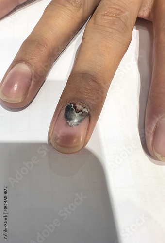 Macro View of Subungual Hematoma and Onycholysis on Human Finger for Medical Diagnosis
