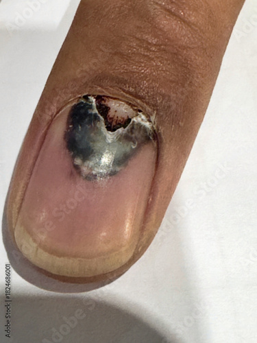 Close-up of a Finger with a Subungual Hematoma and Broken Nail Base Caused by Trauma or Crushing Injury 