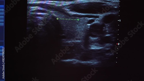 ultrasound scanning of the thyroid gland. Ultrasound image of thyroid gland. Ultrasound scan imaging of thyroid gland
