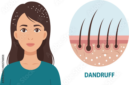 Medical Illustration of Dandruff on Scalp and Hair Follicles