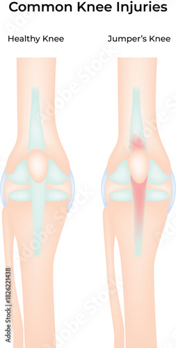 Common Knee Injuries Healthy vs Jumper's Knee Comparison Vector Illustration