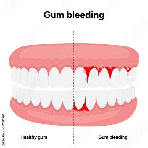 Hand-drawn illustration of healthy teeth and gums alongside bleeding gums, dental and oral anatomy. Dental education, oral health guides, and professional dentistry content