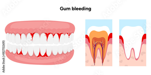 Hand-drawn illustration of bleeding gums, dental and oral anatomy. Ideal for dental education, medical materials, oral health guides, anatomy learning, and professional dentistry content