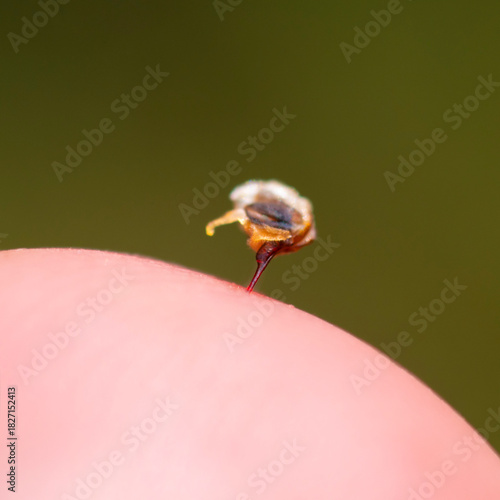 The bee left a sting with a vial of poison in the mans skin.