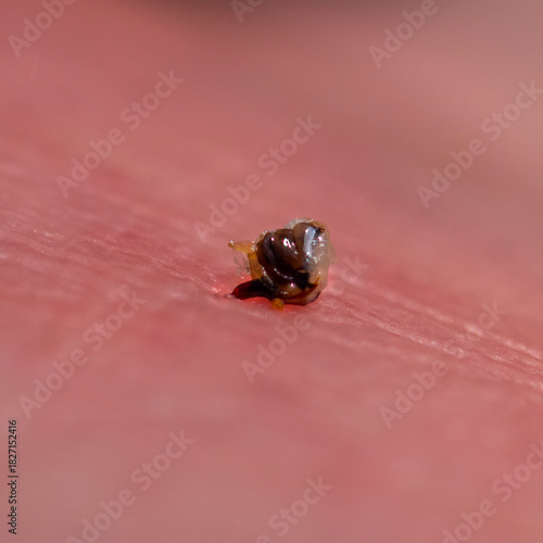The bee left a sting with a vial of poison in the mans skin.