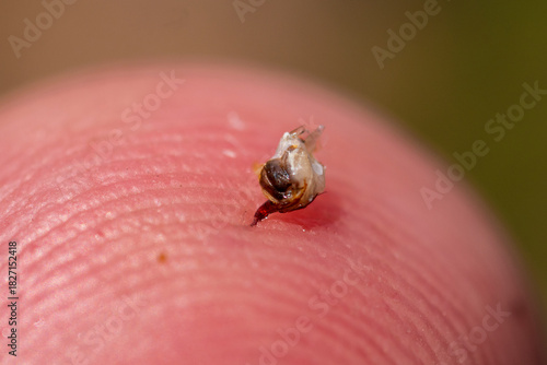 The bee left a sting with a vial of poison in the mans skin.