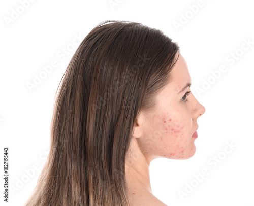 Teenage girl with acne prob...