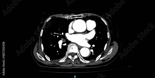 Chest CT scan showing heart, great vessels and mediastinal structures. Axial view with contrast enhancement for diagnostic examination of thoracic anatomy