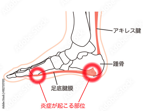 足底筋膜炎　炎症が起こる部位　足底筋膜　足底腱膜