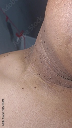 Men with Warts, Skin Tags, or Moles on Dark Skin: Common Skin Lesions and Cosmetic Treatments